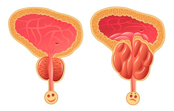 Normálna a zapálená prostata