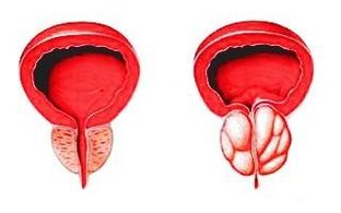 Prostata v normálnom stave (vľavo) a zapálená prostatitídou (vpravo)