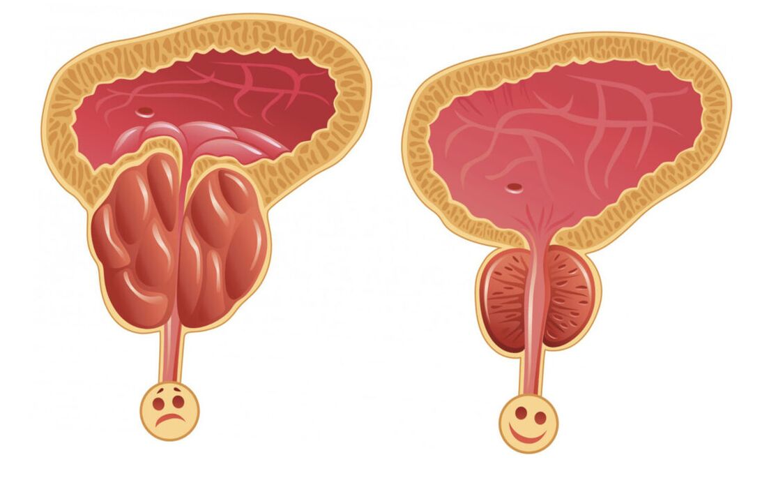 Zápal prostaty s prostatitídou (vľavo) a prostaty je normálny (vpravo)