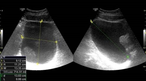 Ultrazvuk prostaty pomôže diagnostikovať prostatitídu u mužov